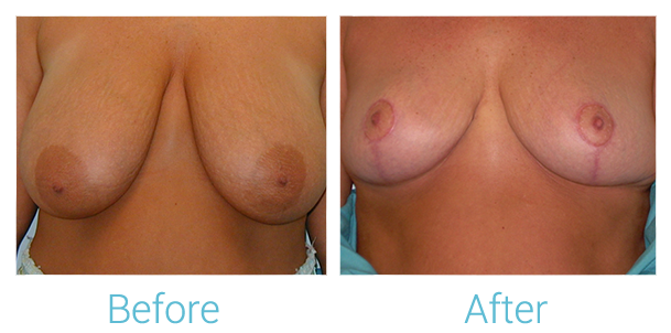 Breast Lift Before & After Gallery - Patient 58151881 - Image 1
