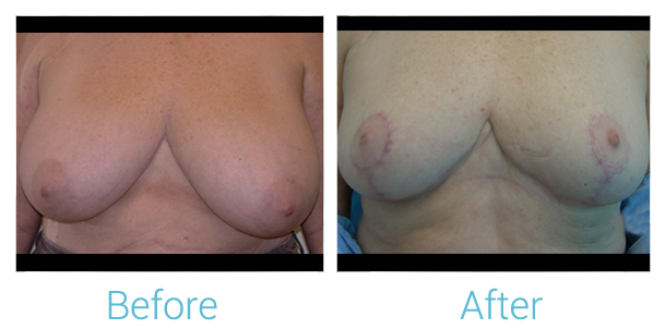 Breast Lift Before & After Gallery - Patient 58151882 - Image 1