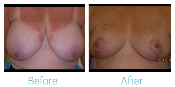 Breast Reduction Before & After Gallery - Patient 58151902 - Image 1