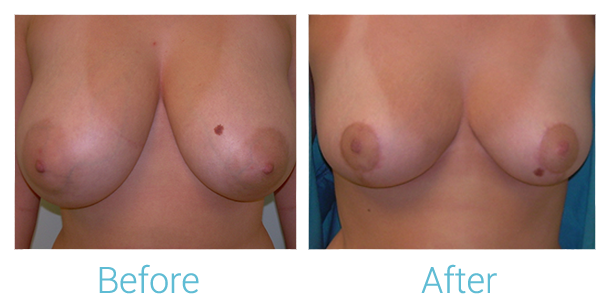 Breast Reduction Before & After Gallery - Patient 58151903 - Image 1