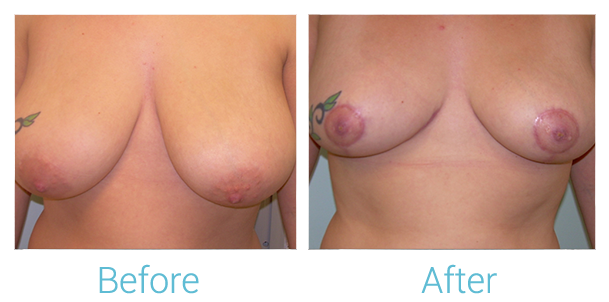 Breast Reduction Before & After Gallery - Patient 58151909 - Image 1
