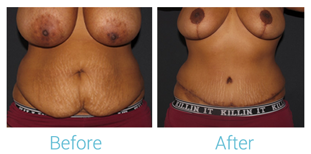 Breast Reduction Before & After Gallery - Patient 58151917 - Image 1