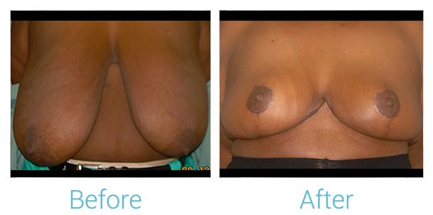 Breast Reduction Before & After Gallery - Patient 58151913 - Image 1
