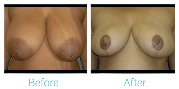 Breast Reduction Before & After Gallery - Patient 58151914 - Image 1