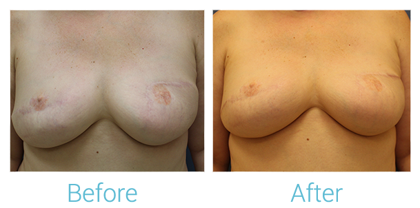 Breast Reconstruction Before & After Gallery - Patient 58151922 - Image 1