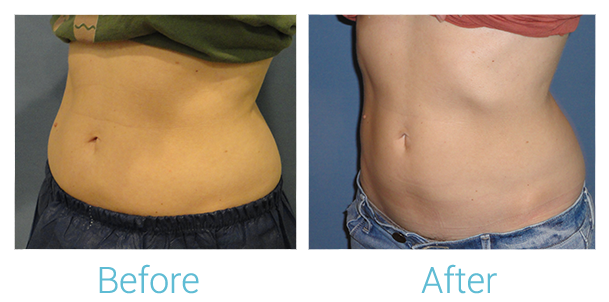 CoolSculpting Before & After Gallery - Patient 58151951 - Image 2