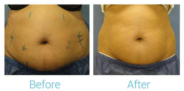 CoolSculpting Before & After Gallery - Patient 58151952 - Image 1