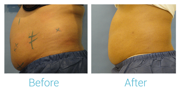 CoolSculpting Before & After Gallery - Patient 58151952 - Image 2