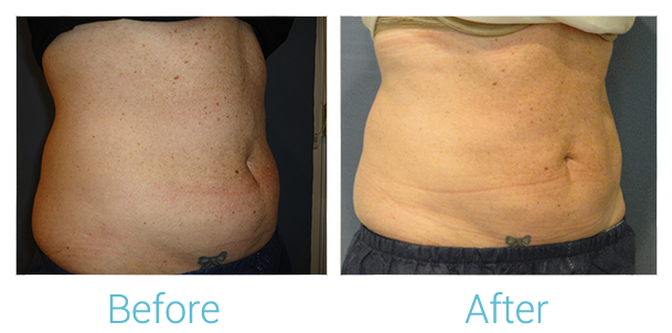 CoolSculpting Before & After Gallery - Patient 58151954 - Image 2