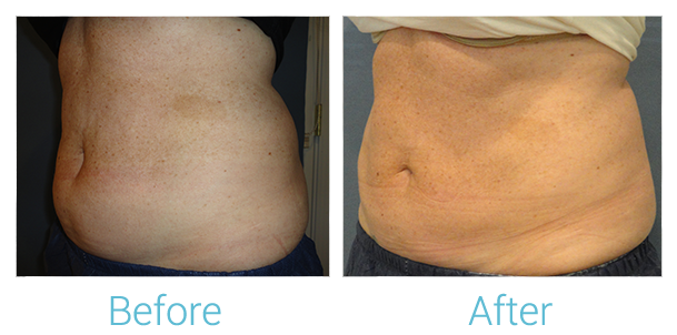 CoolSculpting Before & After Gallery - Patient 58151954 - Image 3