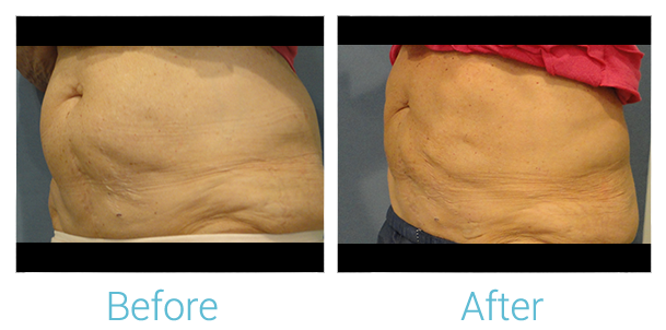 CoolSculpting Before & After Gallery - Patient 58151955 - Image 1