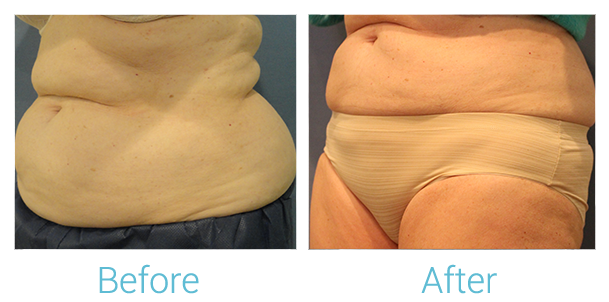 CoolSculpting Before & After Gallery - Patient 58151956 - Image 2