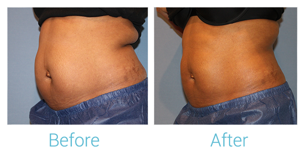 CoolSculpting Before & After Gallery - Patient 58151957 - Image 3