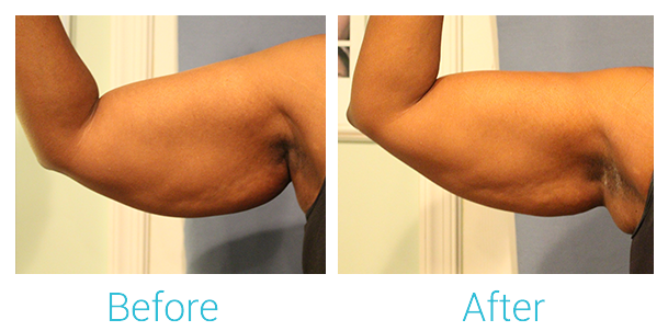 CoolSculpting Before & After Gallery - Patient 58151958 - Image 1