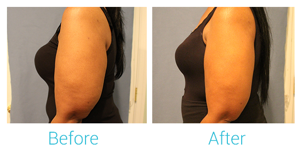 CoolSculpting Before & After Gallery - Patient 58151958 - Image 2