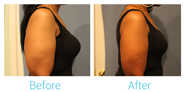 CoolSculpting Before & After Gallery - Patient 58151958 - Image 3