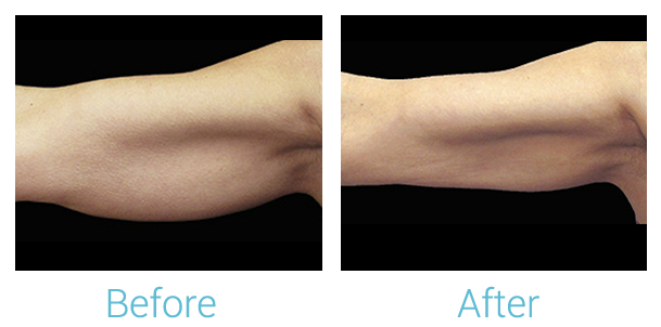 CoolSculpting Before & After Gallery - Patient 58151959 - Image 1