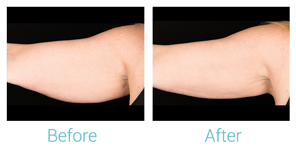 CoolSculpting Before & After Gallery - Patient 58151960 - Image 1