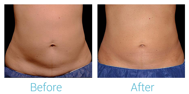 CoolSculpting Before & After Gallery - Patient 58151962 - Image 1