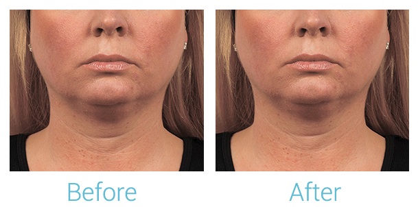 CoolSculpting Before & After Gallery - Patient 58151963 - Image 1