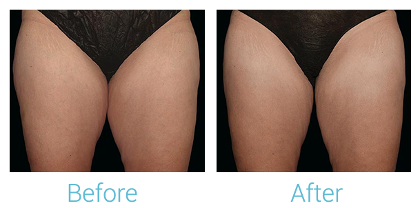 CoolSculpting Before & After Gallery - Patient 58152010 - Image 1