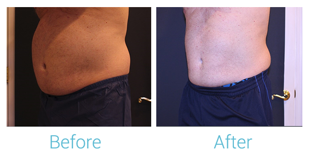 CoolSculpting Before & After Gallery - Patient 58152011 - Image 2