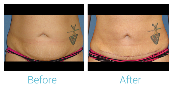 Liposuction Before & After Photos