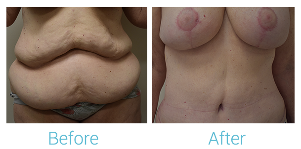 Tummy Tuck Before & After Gallery - Patient 58152086 - Image 1