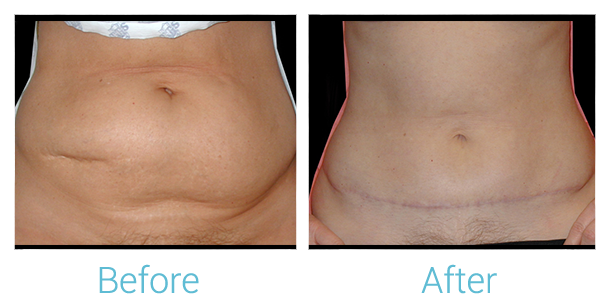 Tummy Tuck Before & After Gallery - Patient 58152077 - Image 1