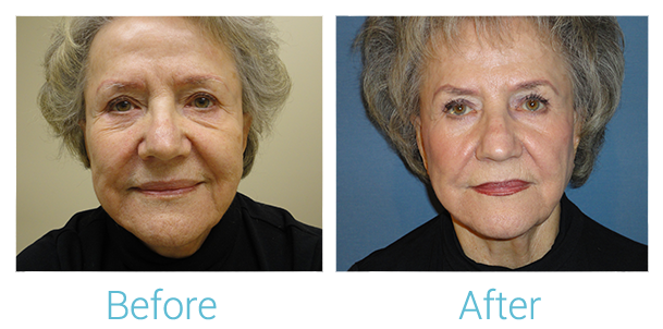 Morpheus8 Before & After Gallery - Patient 58152037 - Image 1