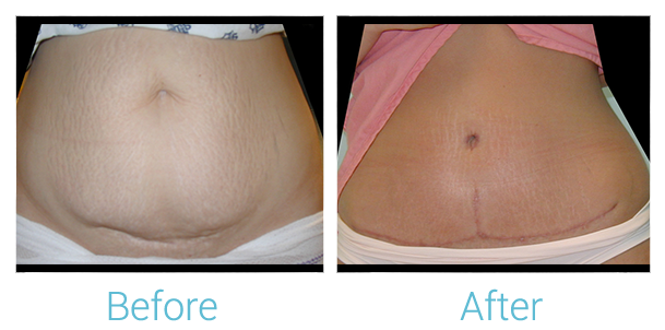 Tummy Tuck & Mini Tummy Tuck for Baltimore, Ellicott City