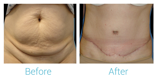 Tummy Tuck Before & After Gallery - Patient 58152060 - Image 1