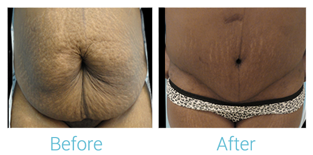 Tummy Tuck Before & After Gallery - Patient 58152073 - Image 1