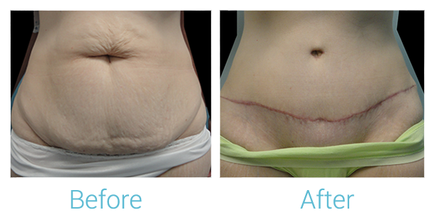 Tummy Tuck Before & After Gallery - Patient 58152074 - Image 1