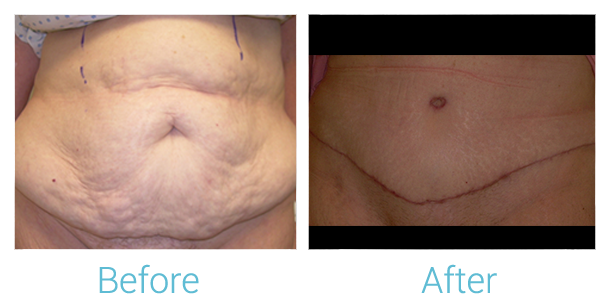 Tummy Tuck Before & After Gallery - Patient 58152075 - Image 1