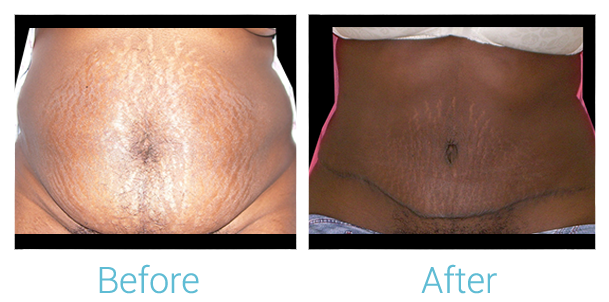 Tummy Tuck Before & After Gallery - Patient 58152078 - Image 1