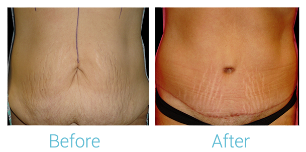 Tummy Tuck Before & After Gallery - Patient 58152079 - Image 1