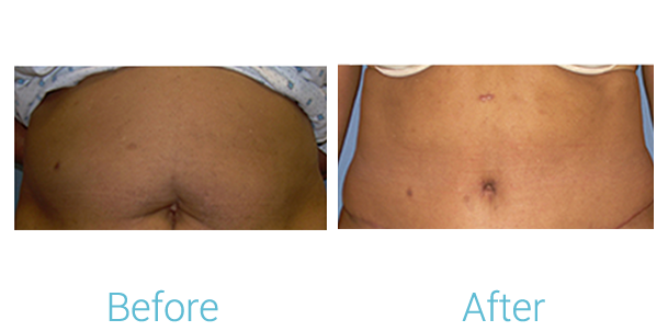 Tummy Tuck Before & After Gallery - Patient 58152080 - Image 1