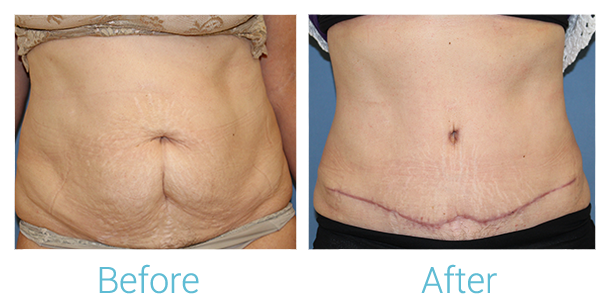 Tummy Tuck Before & After Gallery - Patient 58152081 - Image 1