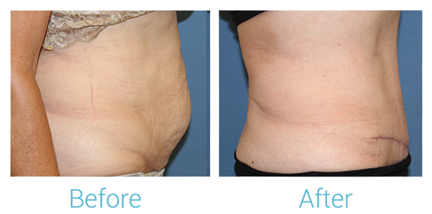 Tummy Tuck Before & After Gallery - Patient 58152081 - Image 2