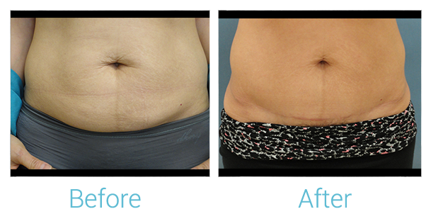 Tummy Tuck Before & After Gallery - Patient 58152082 - Image 1