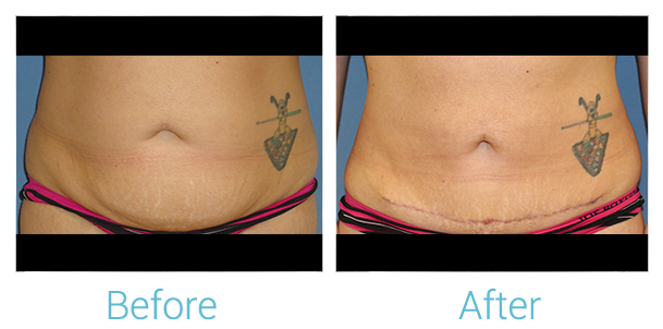 Tummy Tuck Before & After Gallery - Patient 58152083 - Image 1