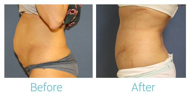 Tummy Tuck Before & After Gallery - Patient 58152085 - Image 1