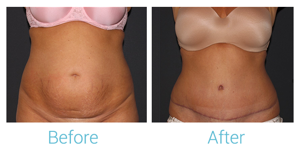 Tummy Tuck Before & After Gallery - Patient 58152087 - Image 1