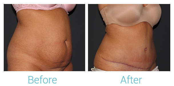Tummy Tuck Before & After Gallery - Patient 58152087 - Image 3
