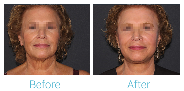 Facelift Before & After Gallery - Patient 58152102 - Image 1