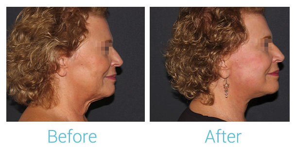 Facelift Before & After Gallery - Patient 58152102 - Image 3