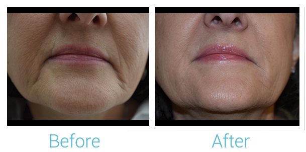 Fillers Before & After Gallery - Patient 58152116 - Image 1
