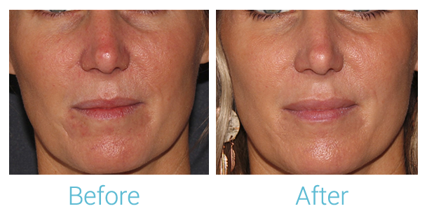 Fillers Before & After Gallery - Patient 58152123 - Image 1