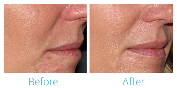 Fillers Before & After Gallery - Patient 58152124 - Image 1